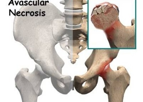 Femur Başı Avasküler Nekrozu Avn
