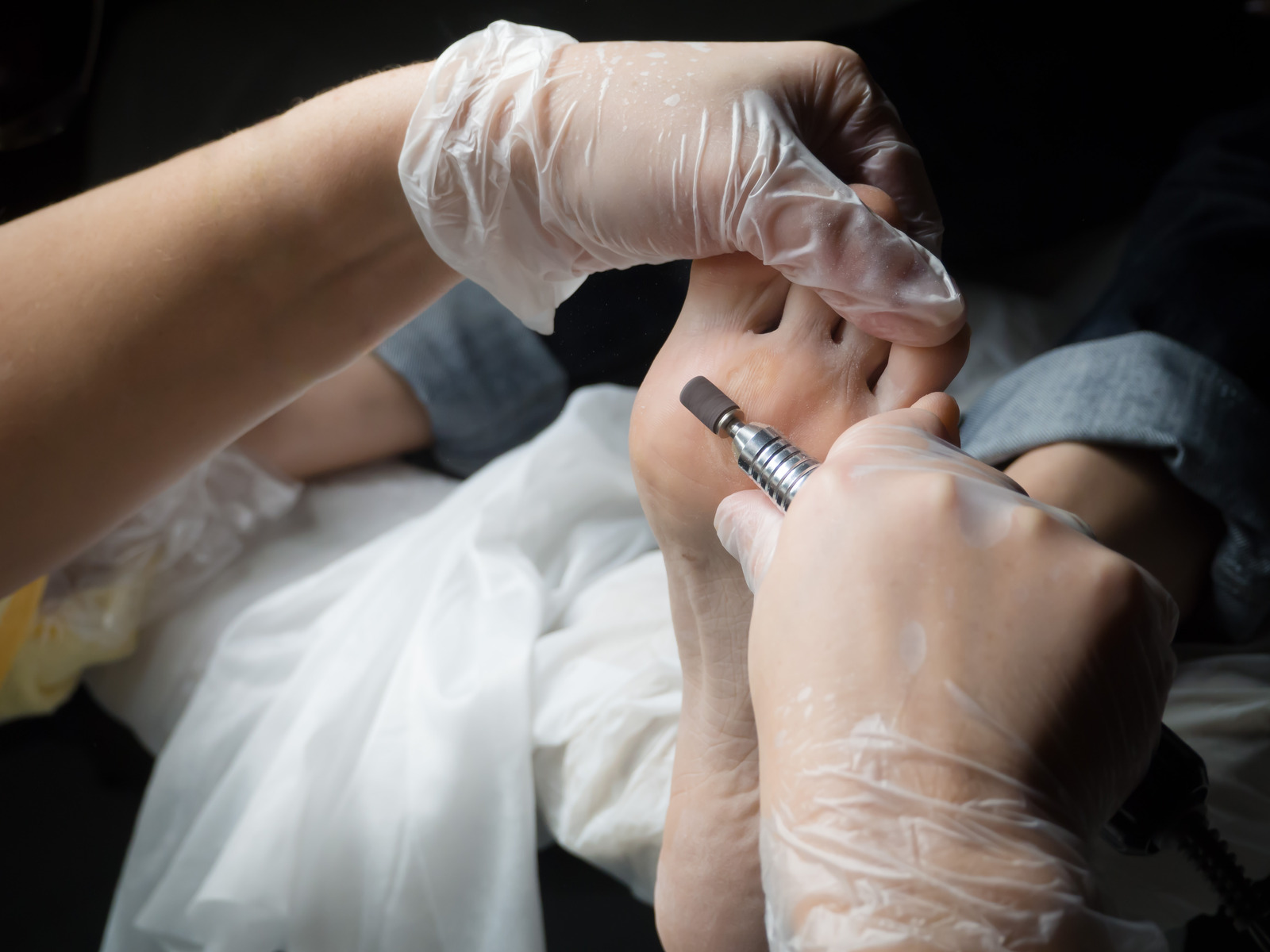Sindirella Cerrahisi Cinderella Surgery Ayak Estetiği Nedir